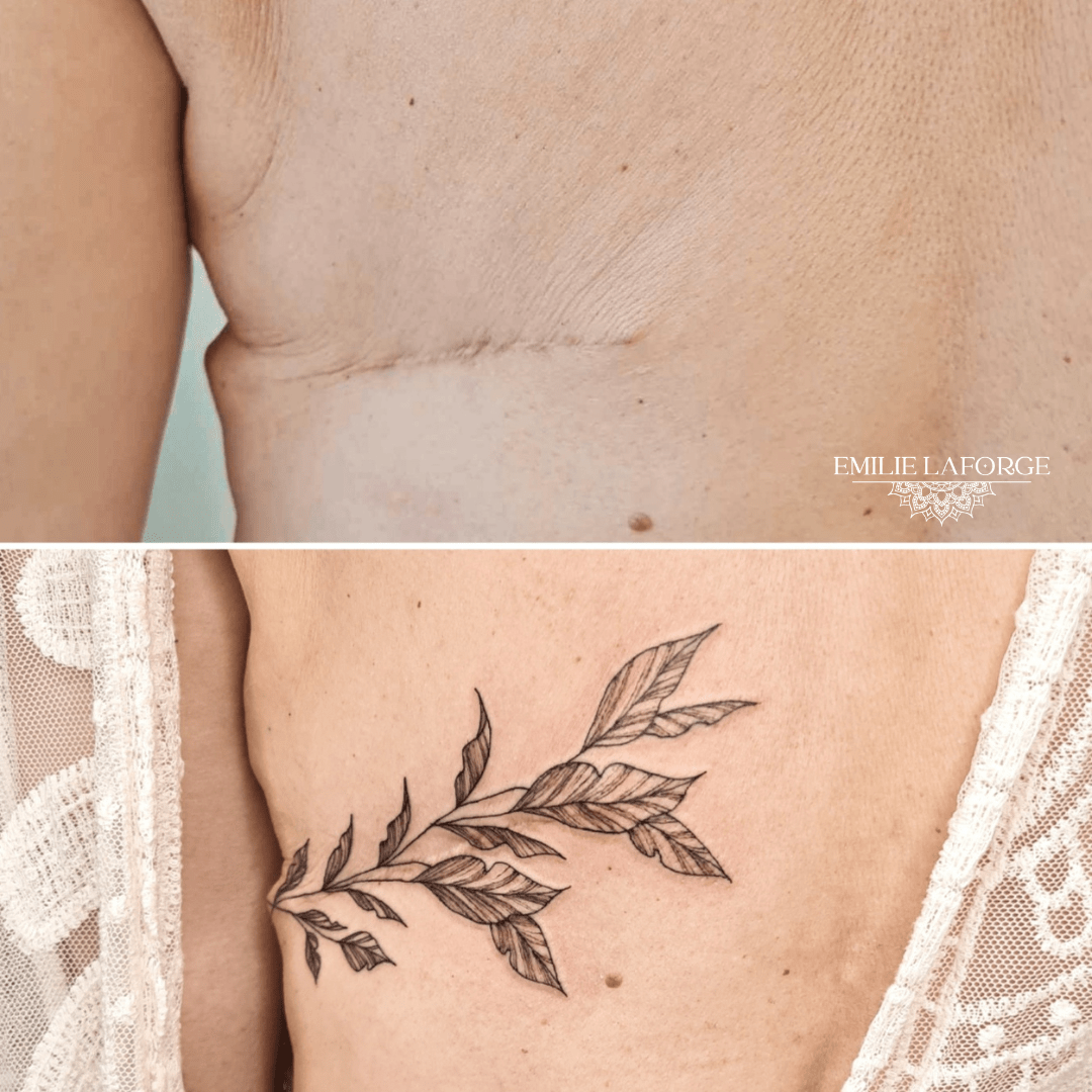 tatouage brulure hérault