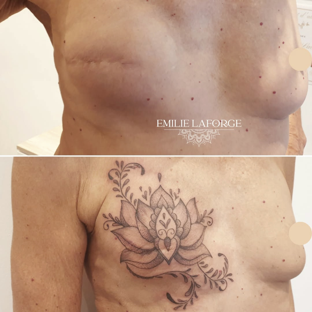tatouage sur cicatrice hérault tatouage sur cicatrice hérault