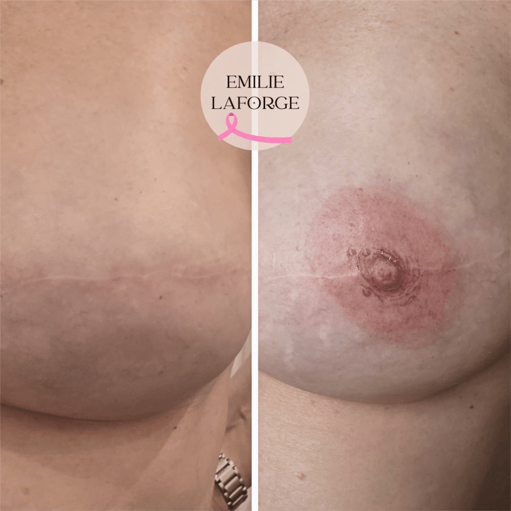 tatouage cancer du sein villeneuve-les-beziers tatouage cancer du sein villeneuve-les-beziers